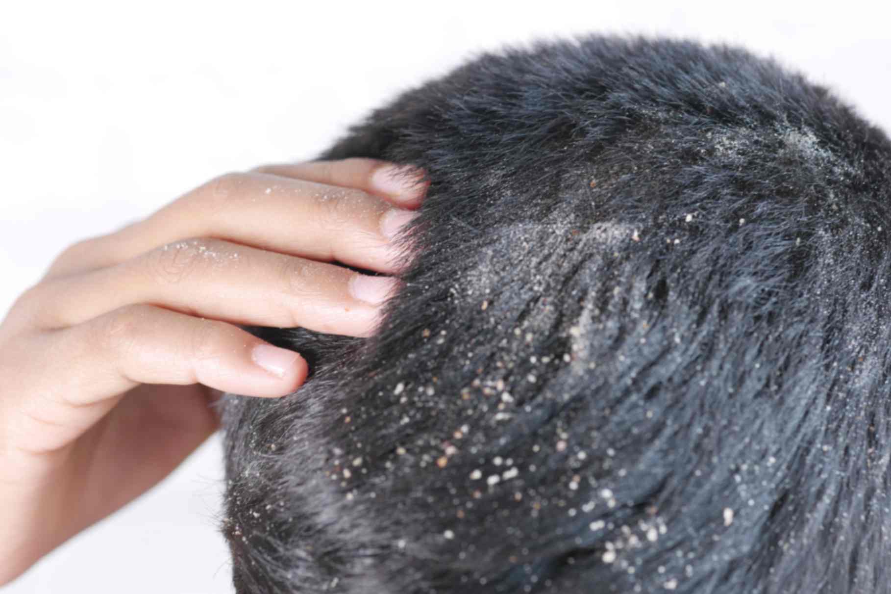 Dandruff Treatment