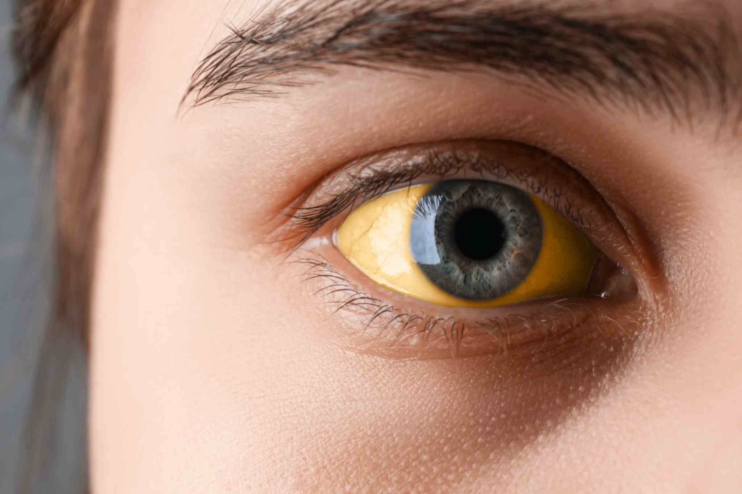 Jaundice Treatment