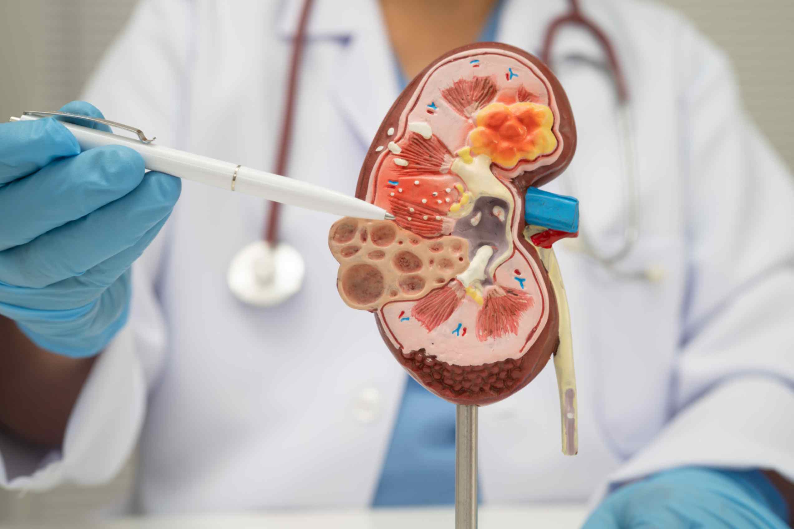 Kidney Stones