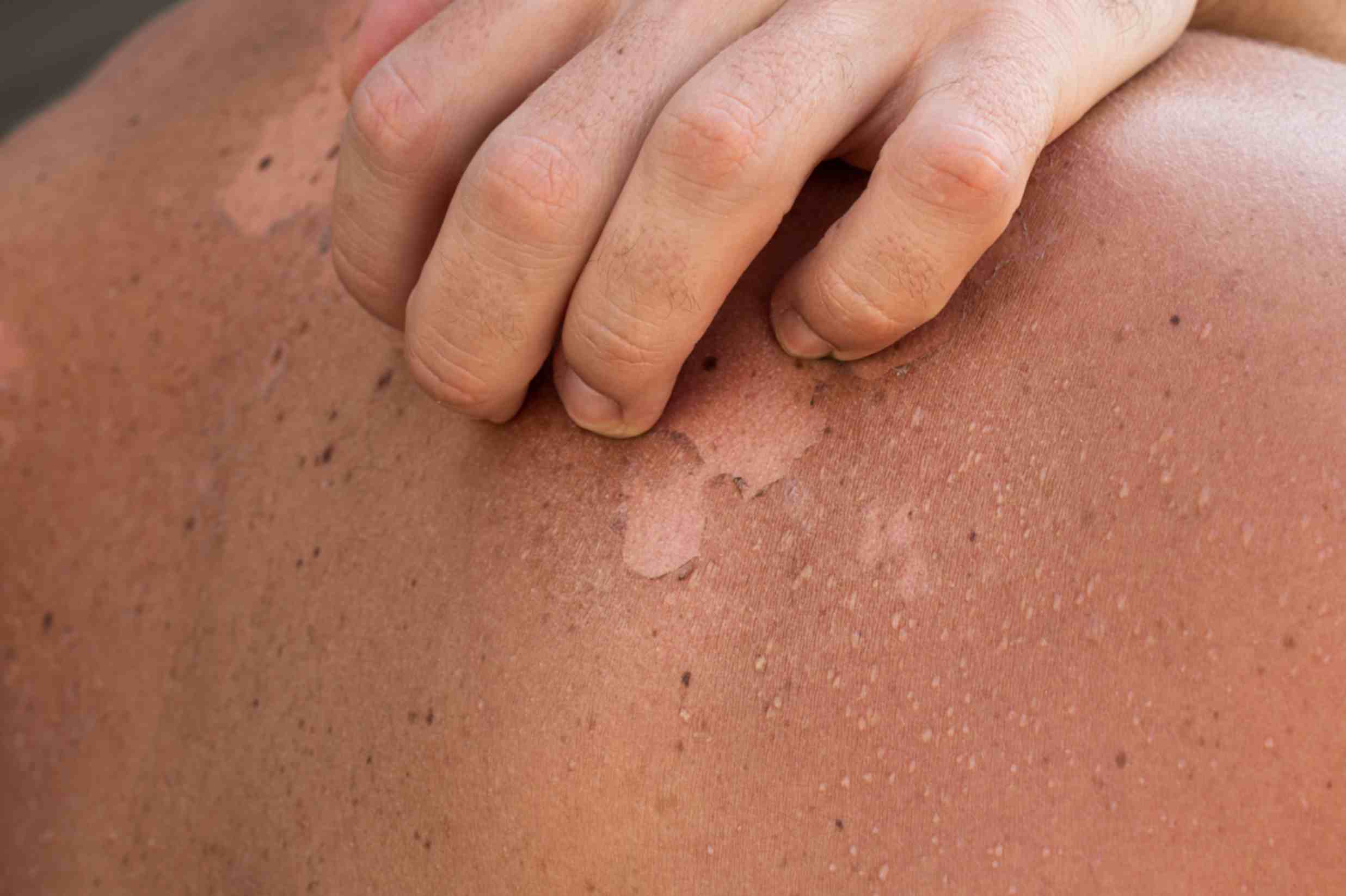 Skin Disorders