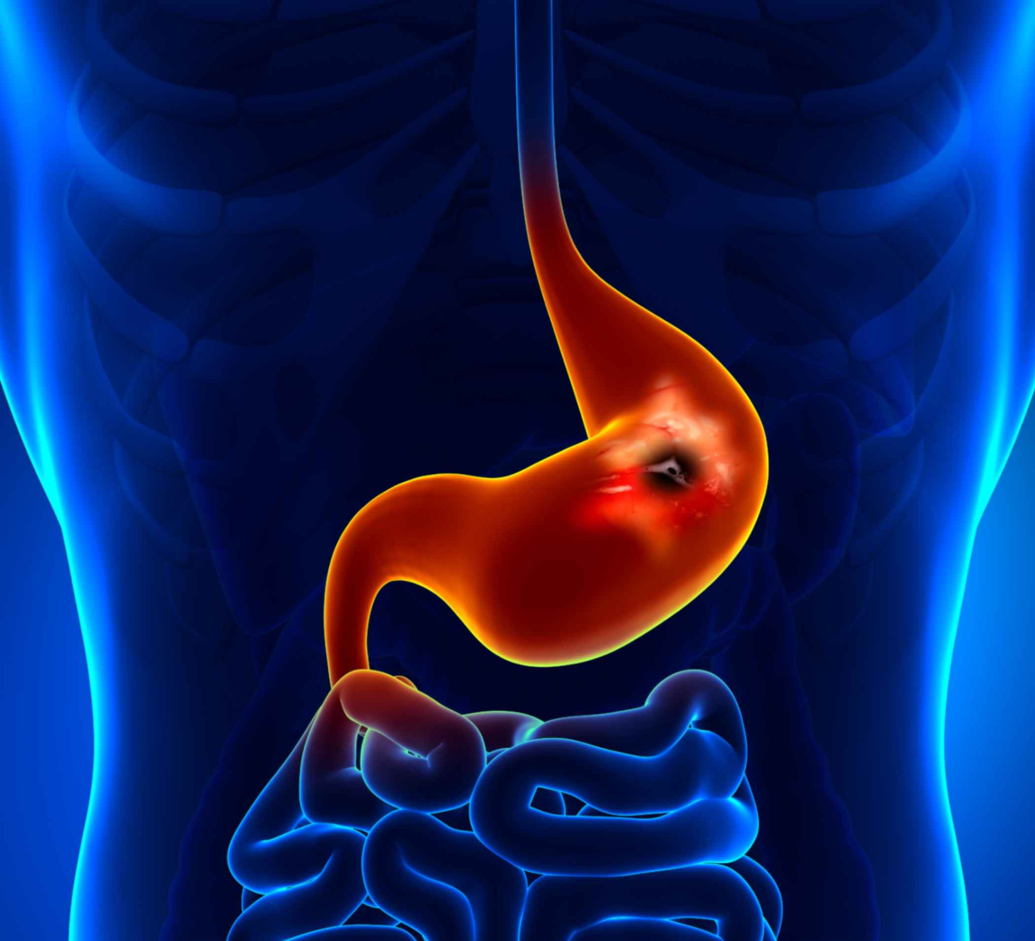 Ulcer Treatment